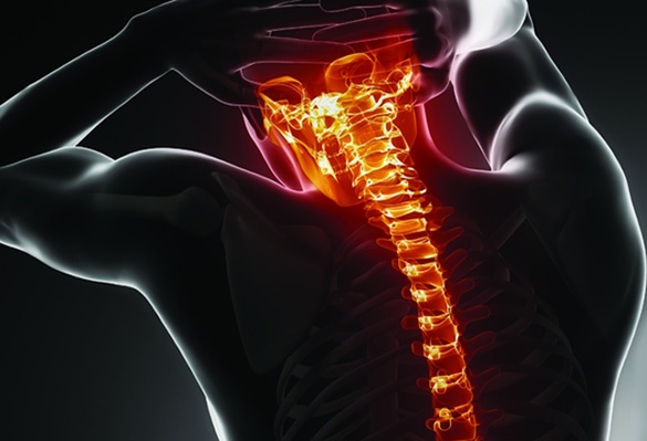 Using Advances in Medicine to Manage Scoliosis | Indonesia Expat